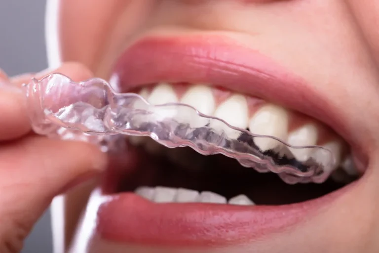 Invisalign — Invisible Aligners for Straightening Teeth